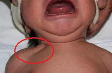Frattura della clavicola in un neonato: cause, conseguenze, trattamento